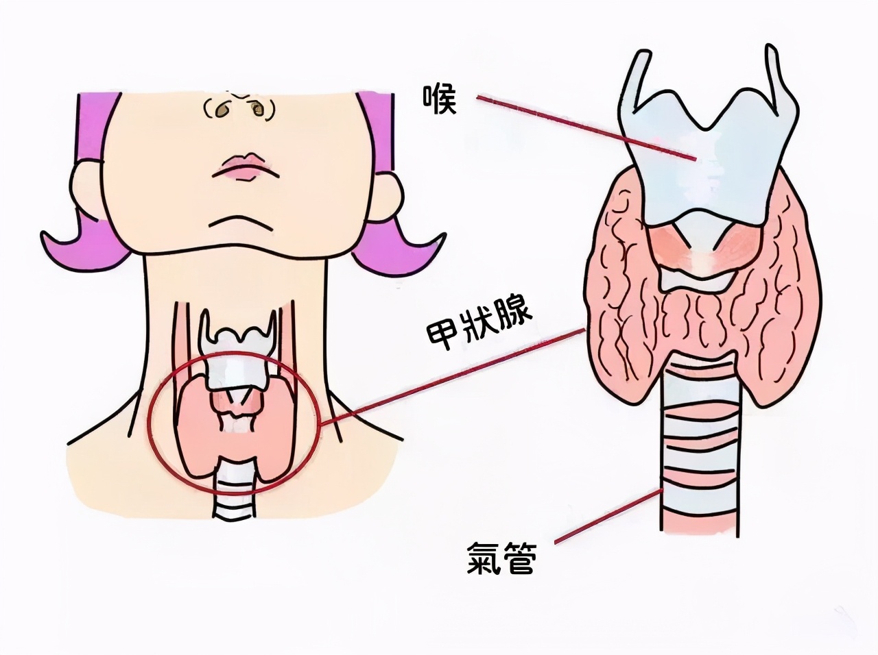 甲状腺癌5.jpg