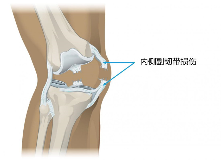 膝盖内侧疼痛，有几种原因？医生告诉您该怎么办