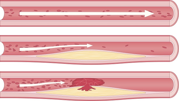 atherosclerosis illustration2.jpg