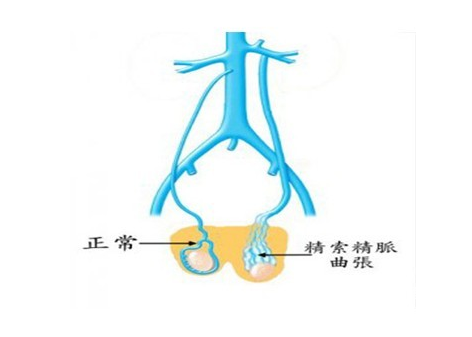 十问十答精索静脉曲张:竟是男性不育元凶?