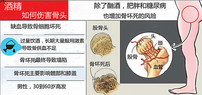 喝酒爱干杯，喝多少，怎么喝？才能避免股骨头坏死