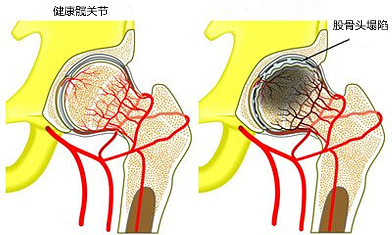 喝酒爱干杯，喝多少，怎么喝？才能避免股骨头坏死