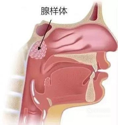 腺样体.png