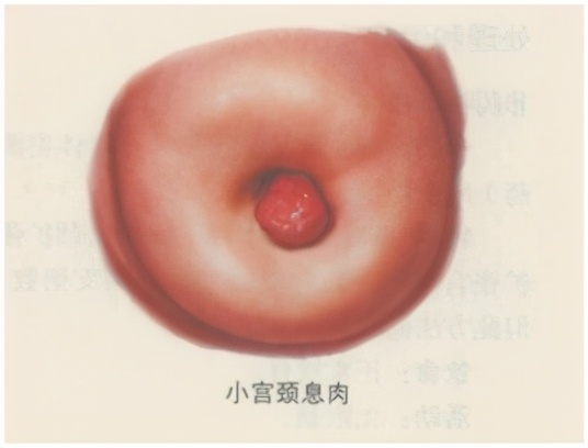 同房后出血，是怎么回事？