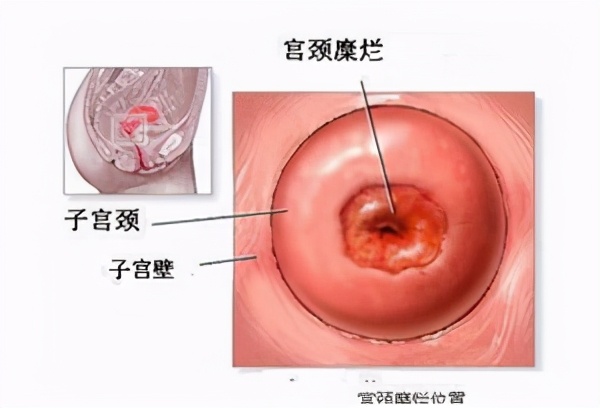 同房后出血，是怎么回事？