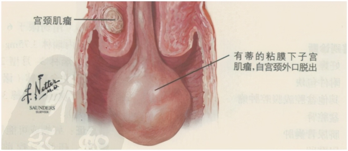 同房后出血，是怎么回事？