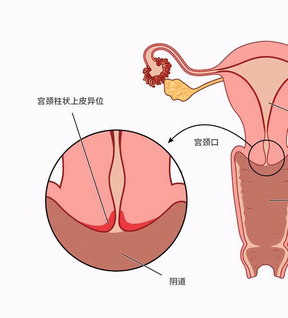 不可不知的“宫颈糜烂”