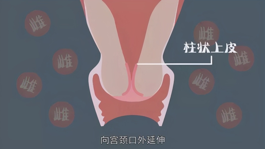 不可不知的“宫颈糜烂”