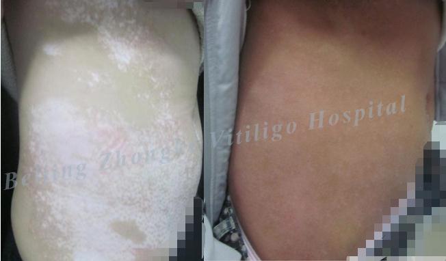 大面积（侧腹部）.jpg