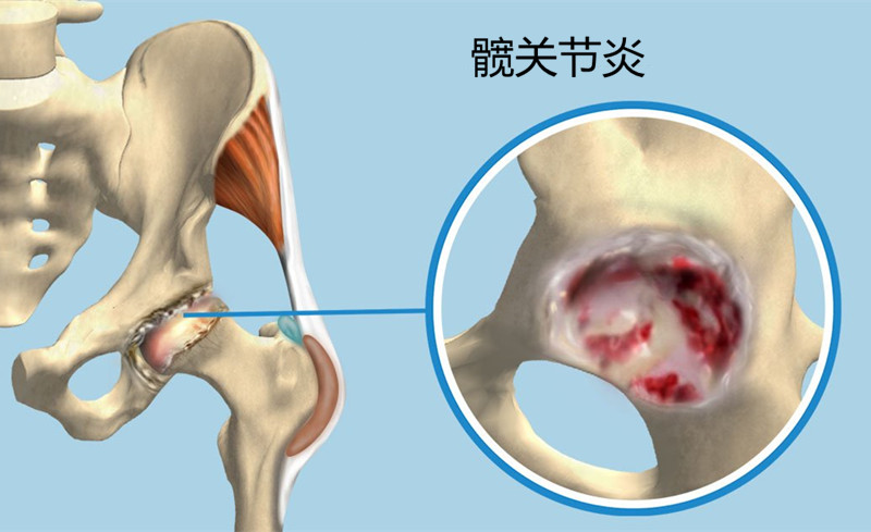 人工髋关节置换可怕吗？来看一位患者的术后8周日记