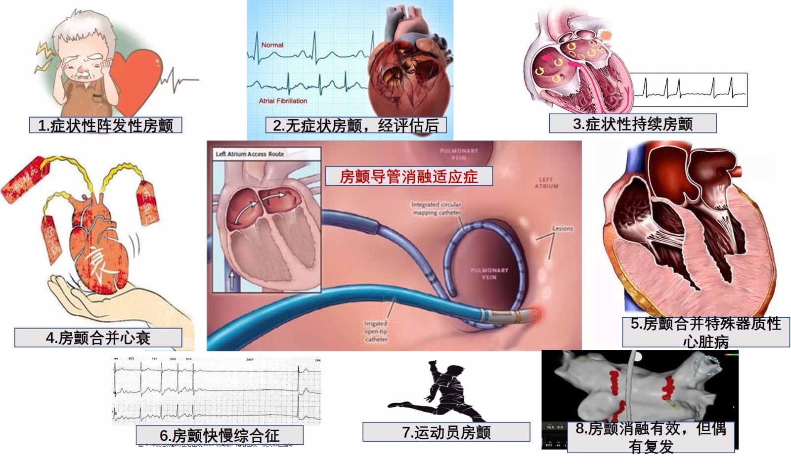 房颤导管消融指征.jpg