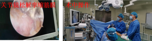 关节镜微创治疗臀肌挛缩症（弹响髋）