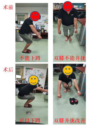 关节镜微创治疗臀肌挛缩症（弹响髋）