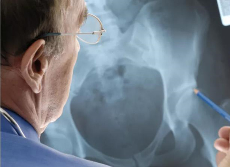 股骨头坏死会扩散吗？您可能关心的12个问题