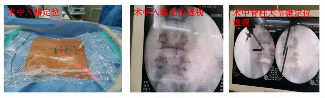 首例！深圳市中医院成功采用UBE技术微创治疗腰椎间盘突出患者