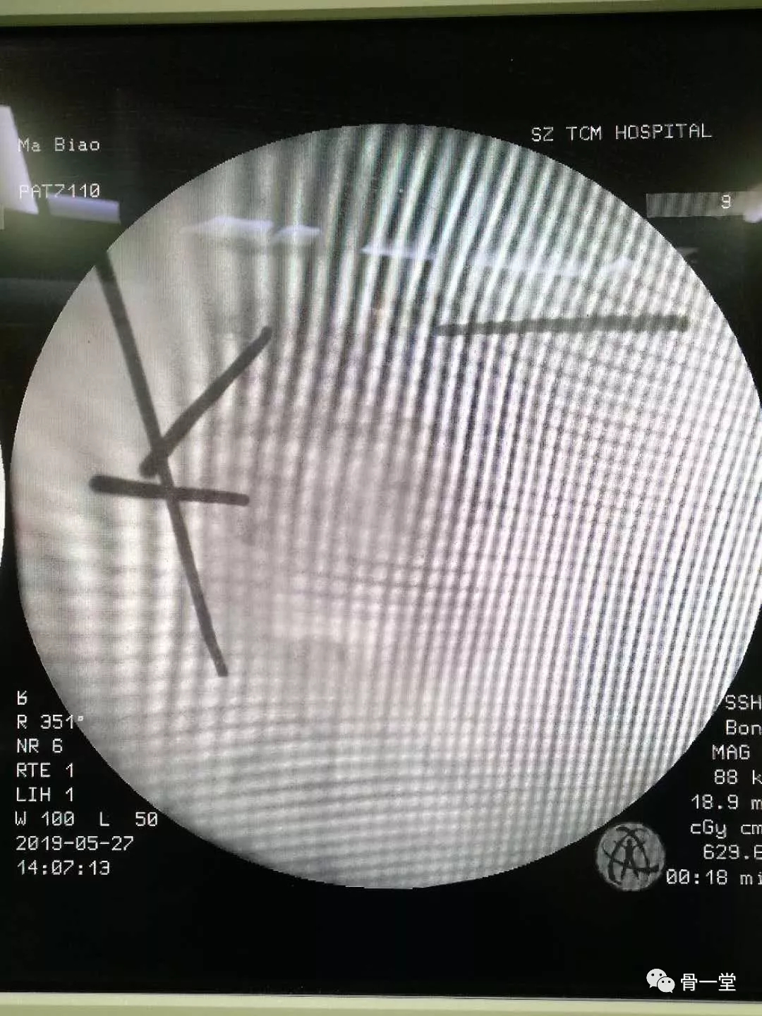 真正的脊柱微创-misTLIF入路经脊柱内镜下椎管减压融合治疗