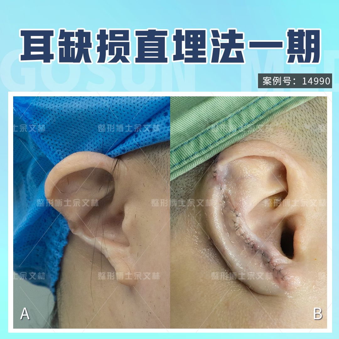 第八节 耳部烧伤后畸形缺损的修复