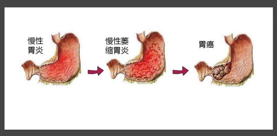 胃炎.jpg