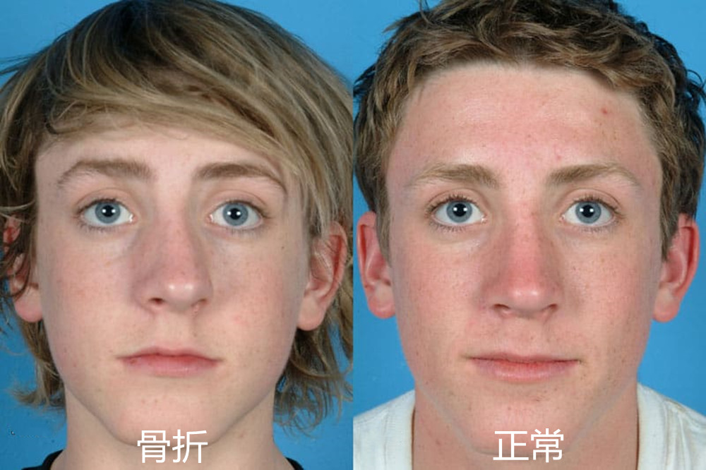 商家动不动就打骨折，哪块骨头容易骨折？骨科医生告诉你