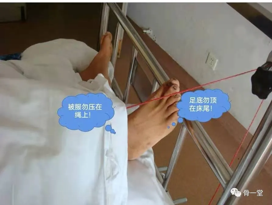 骨牵引健康宣教