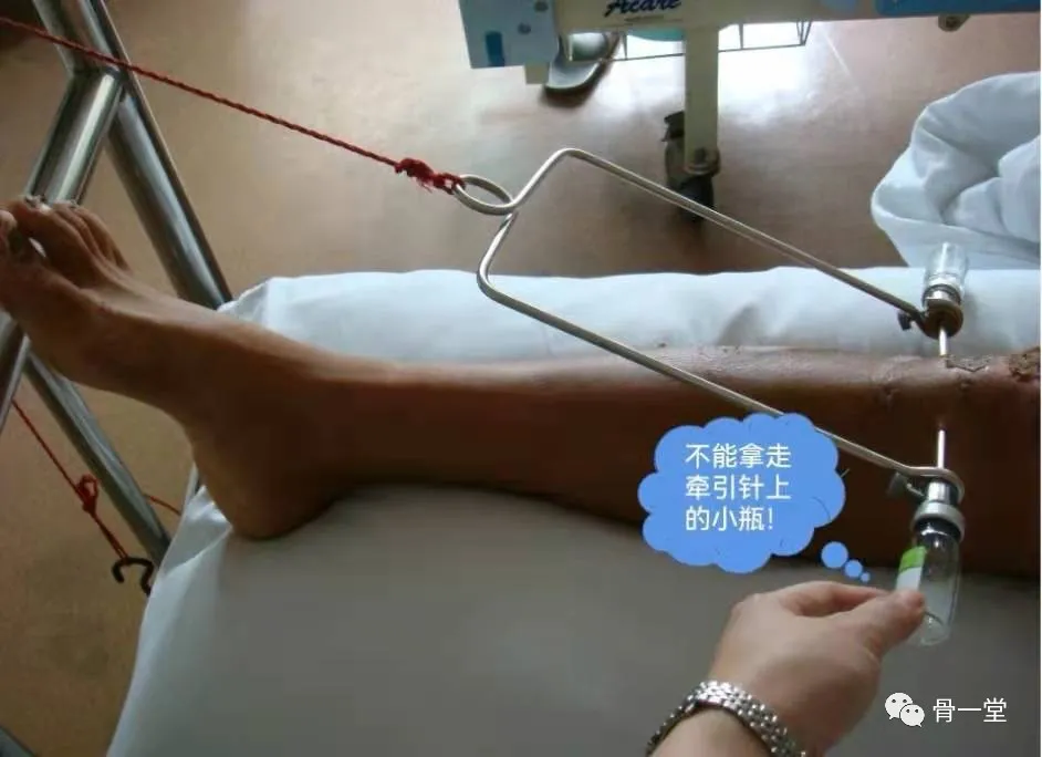 骨牵引健康宣教