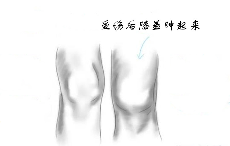 膝盖受伤不一定去医院，除非有这5种迹象