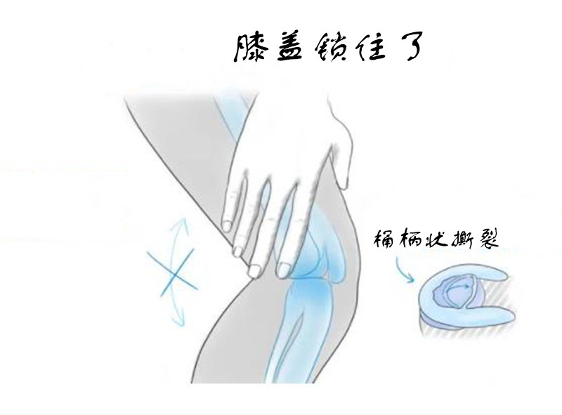 膝盖受伤不一定去医院，除非有这5种迹象