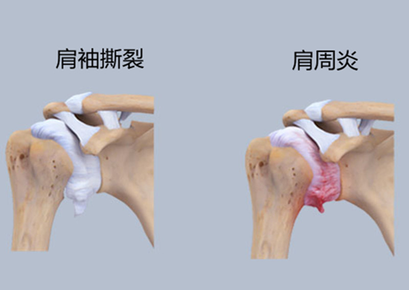 肩周炎治错就麻烦了，还有一种病容易混淆，它叫肩袖撕裂