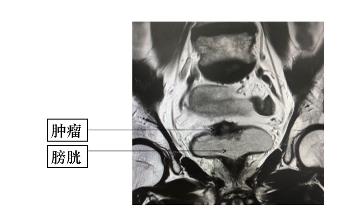 160膀胱肿瘤.png