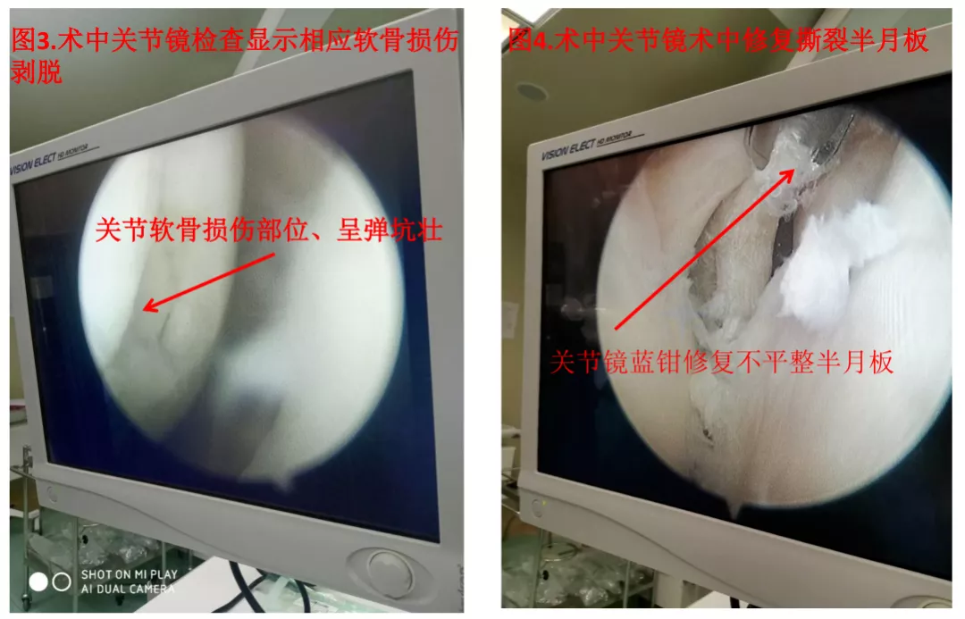 大姐膝盖一直疼，一查竟是半月板撕裂！关节微创小手术解决大问题