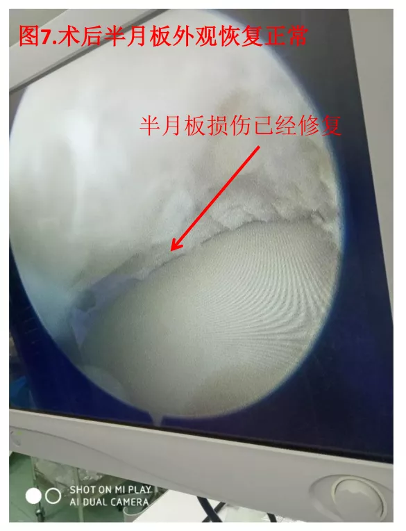 大姐膝盖一直疼，一查竟是半月板撕裂！关节微创小手术解决大问题