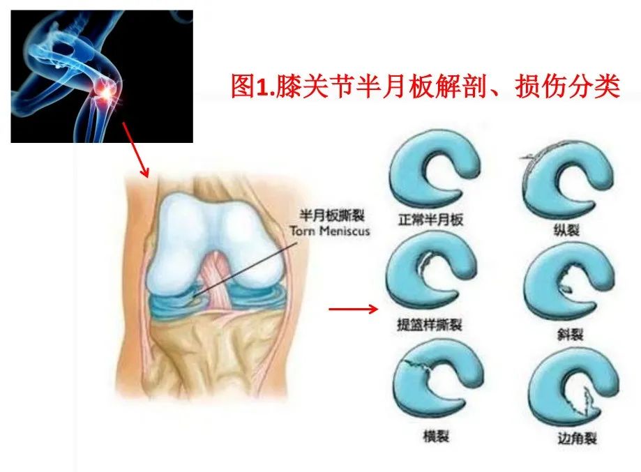 大姐膝盖一直疼，一查竟是半月板撕裂！关节微创小手术解决大问题