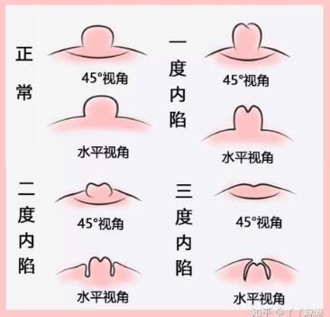 乳头内陷 (3).png