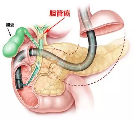 胆管癌也不是不能防！出现这些情况，一定要重视