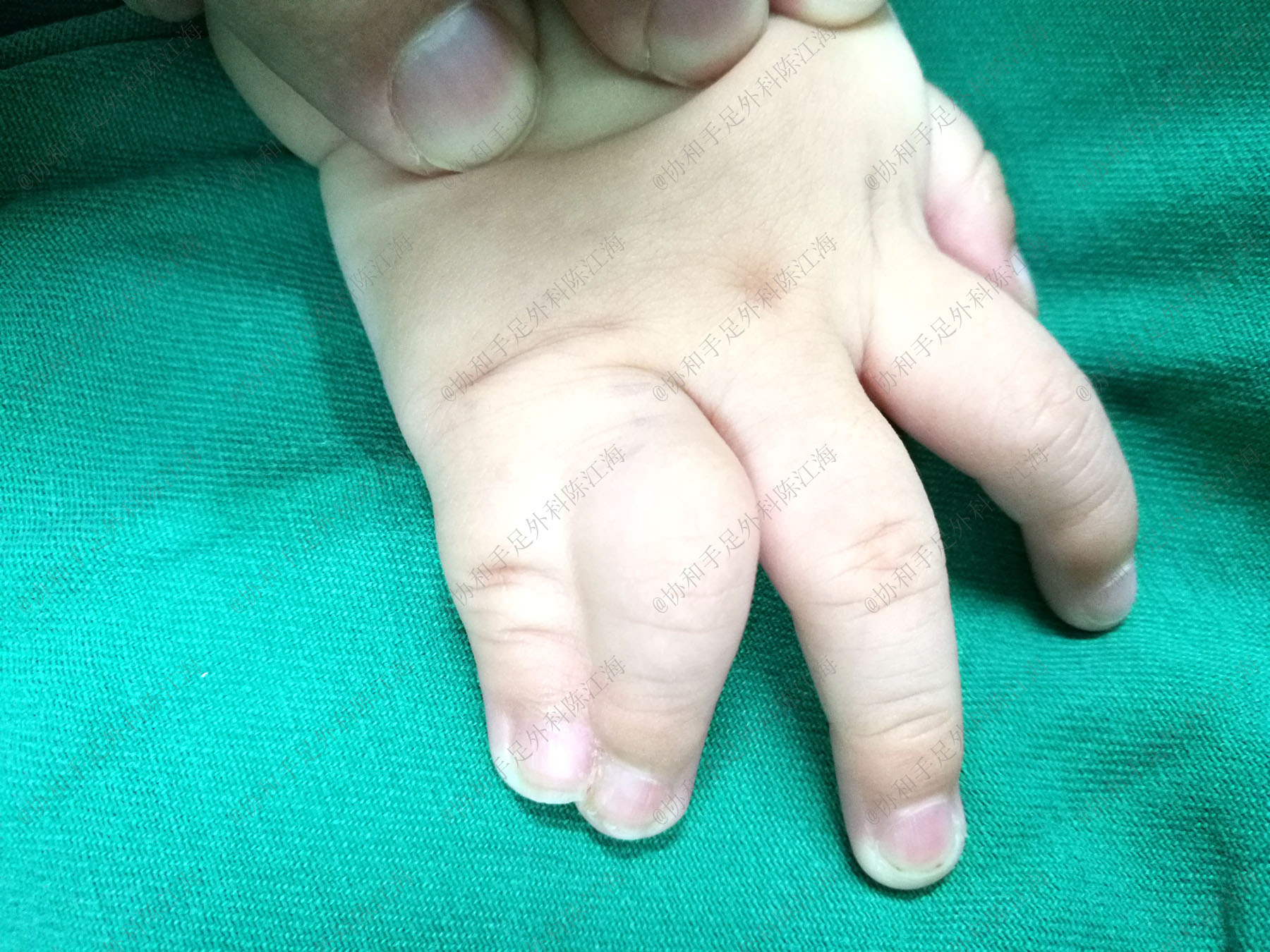 宝宝并指手术需植皮，妈妈哭求用自己的，医生：现在有免植皮技术