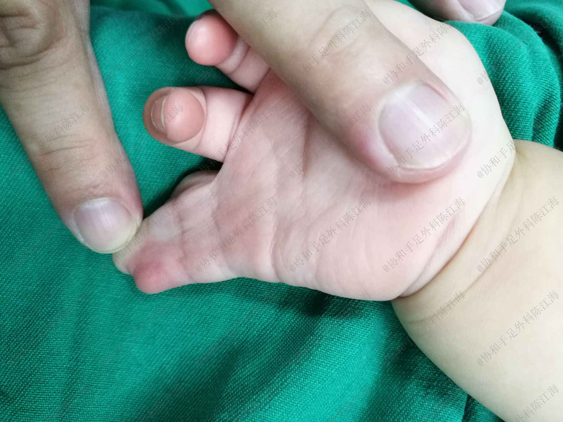 宝宝并指手术需植皮，妈妈哭求用自己的，医生：现在有免植皮技术