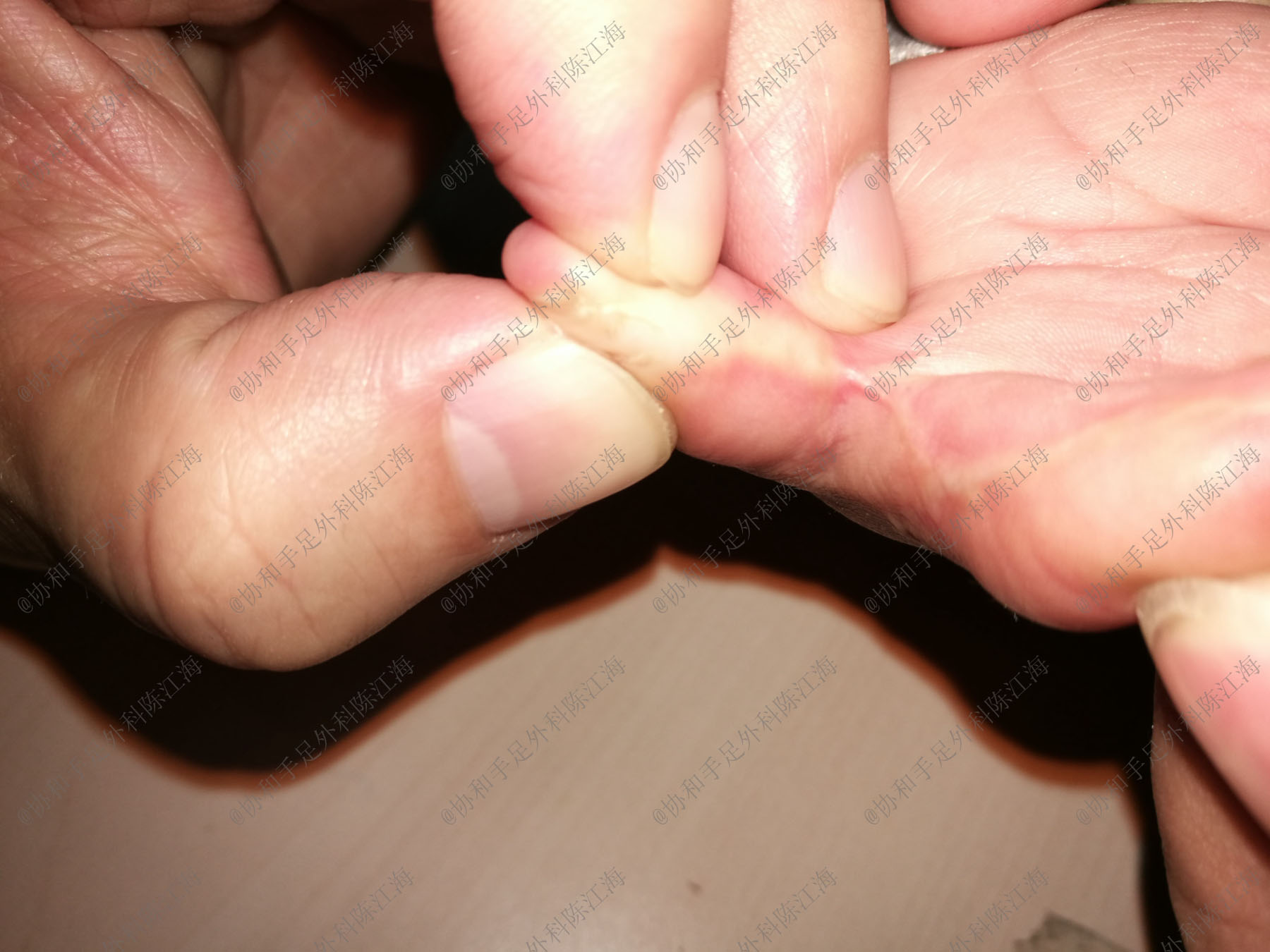 宝宝并指手术需植皮，妈妈哭求用自己的，医生：现在有免植皮技术