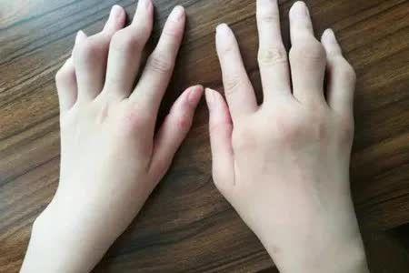 类风湿关节炎.jpg