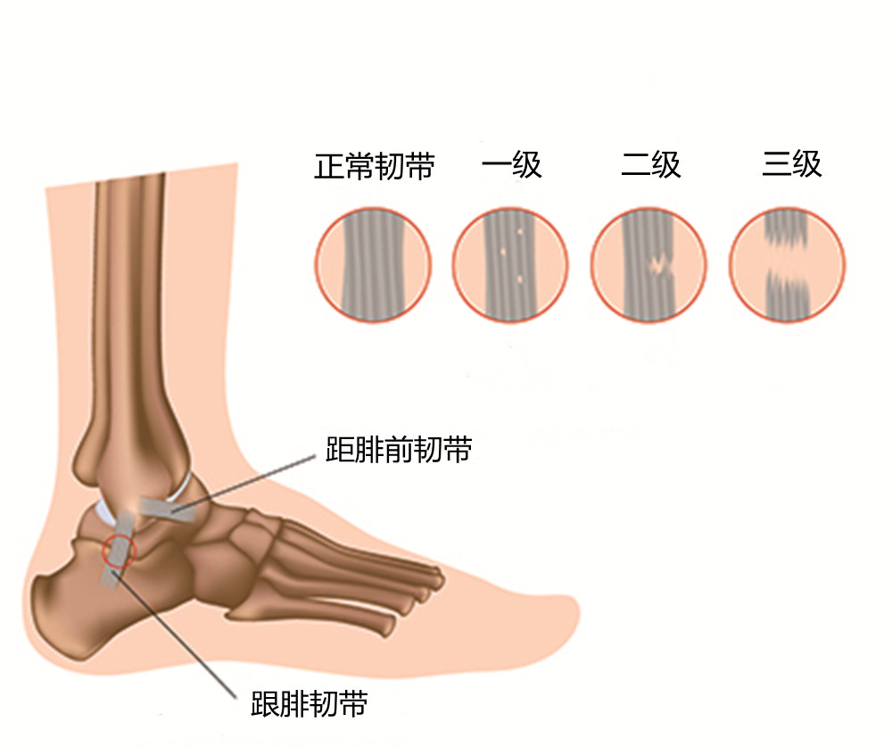 崴脚后疼痛肿胀，感觉差不多，怎么判断是扭伤还是骨折