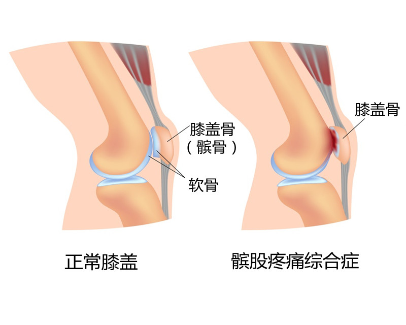 髌股疼痛综合征，困扰女同胞的膝盖疼痛，为什么？怎么办？