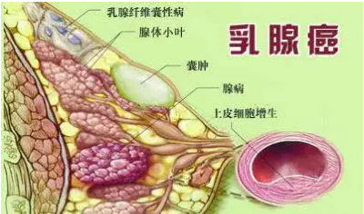 乳腺癌.png