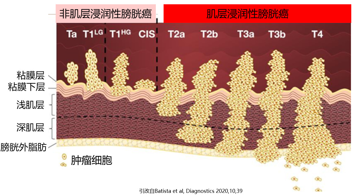 膀胱肿瘤浸润.png