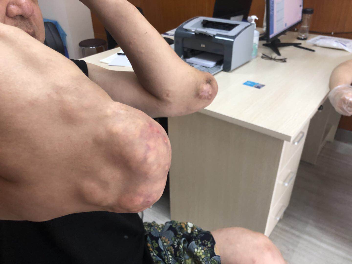 痛风石 (6).jpg