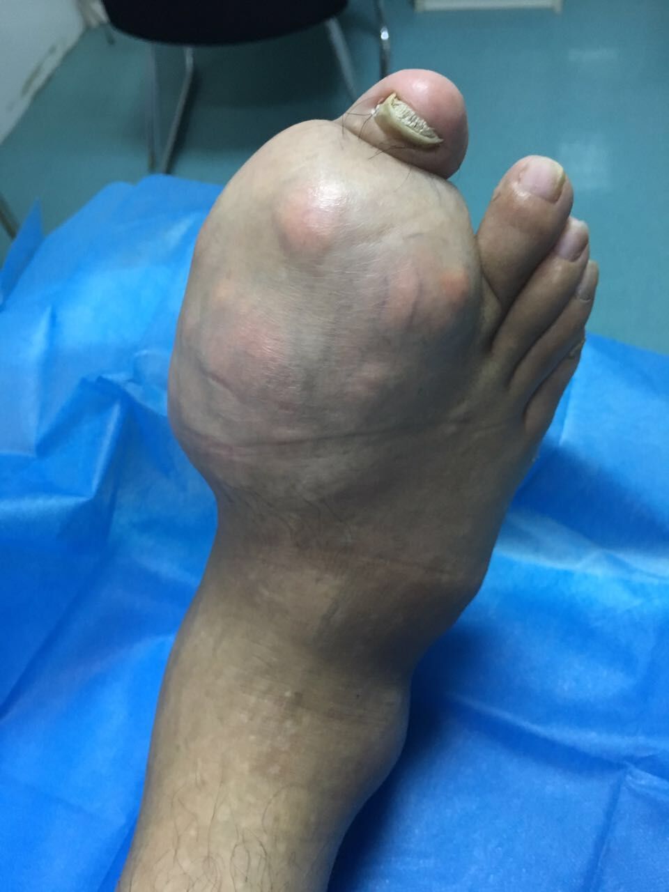 痛风石 (1).jpg