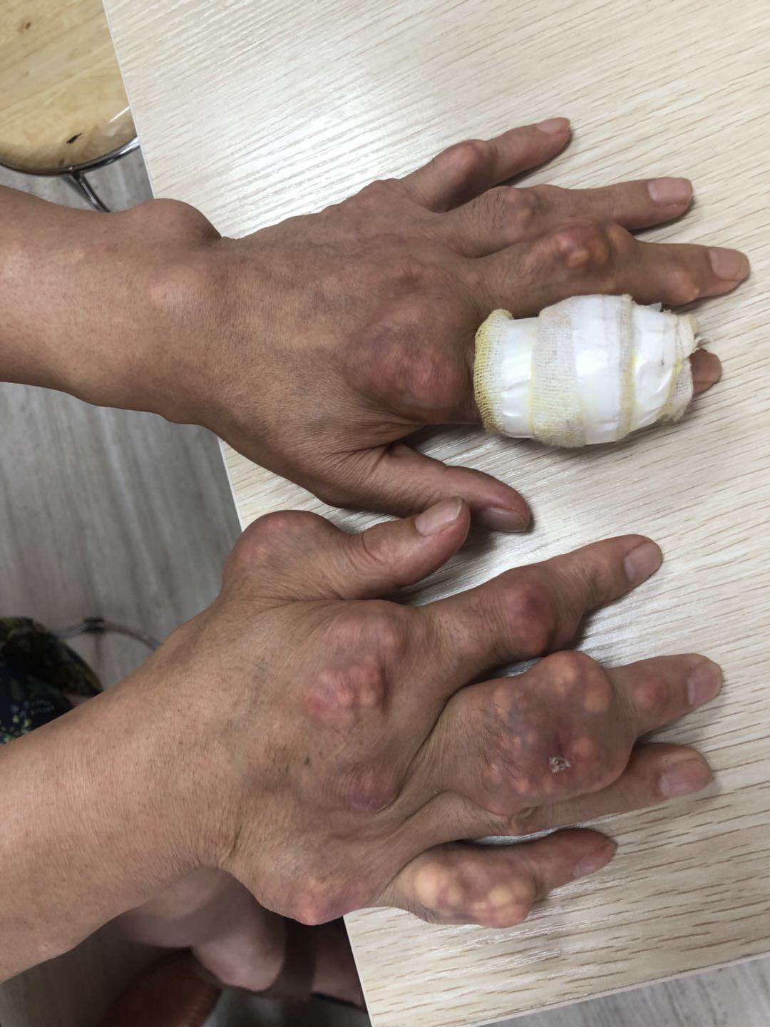 痛风石 (5).jpg