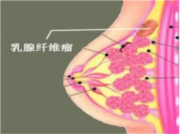 纤维瘤.png