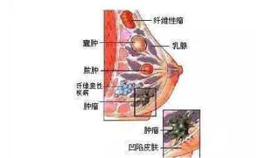 乳腺纤维瘤1.png