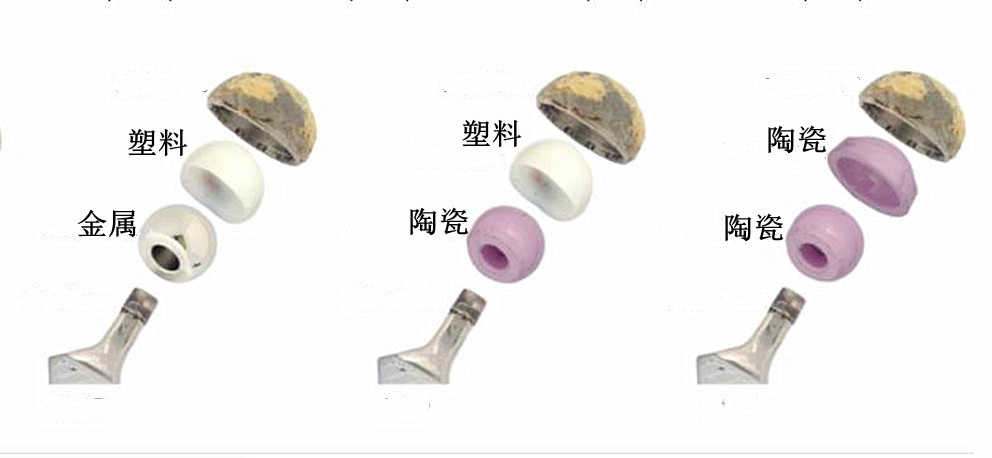 想做髋关节置换手术？这5件事很重要，医生来告诉你