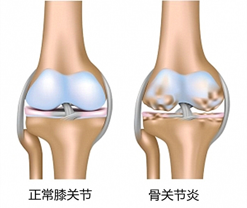 膝盖发出响声的几个原因，有些需要警惕，有些就不必