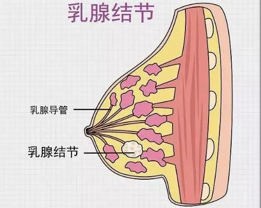 內部通常是液體,發生感染時會變成乳腺膿腫